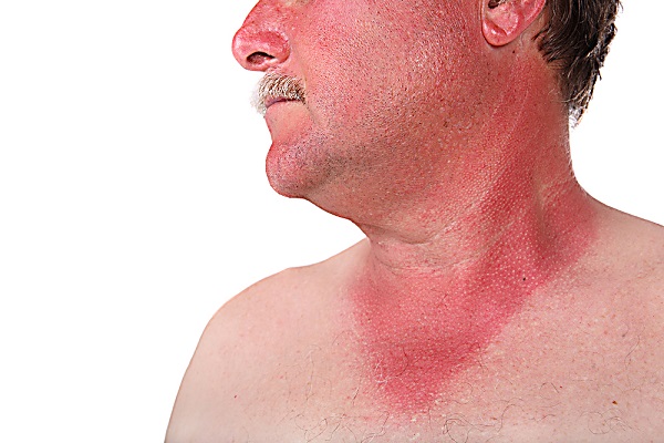 Геморрагическая сыпь (пурпура на коже) у детей и взрослых: причины, симптомом каких заболеваний является, лечение