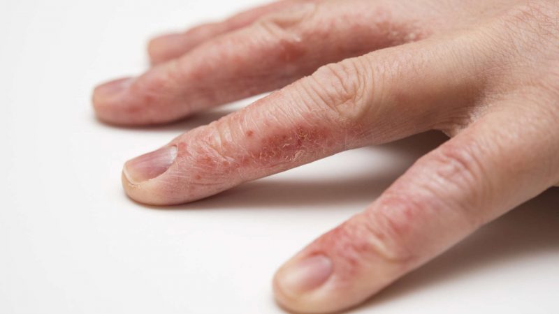 Псориаз на руках: симптомы и лечение чешуйчатого лишая
