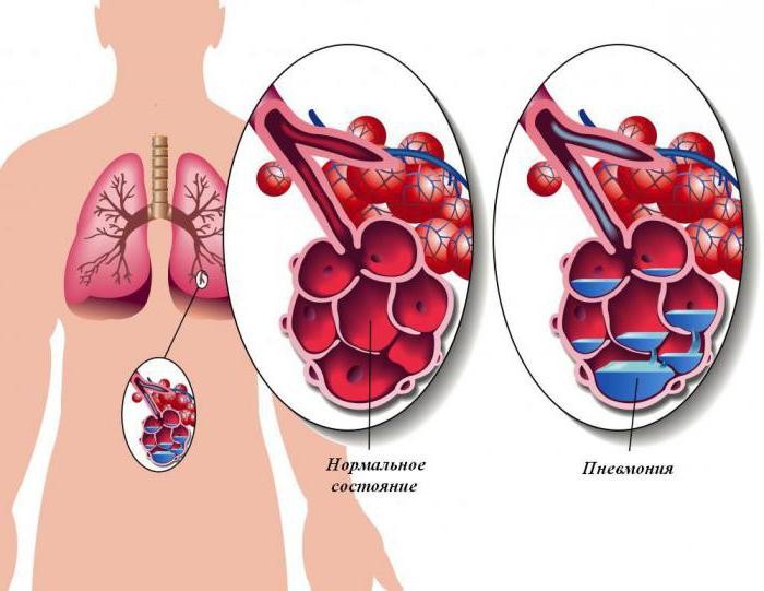Что такое пневмония: симптомы у взрослых и детей, диагностика, виды, возможные осложнения, лечение заболевания