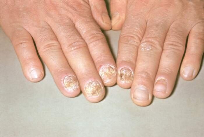 Псориаз ногтей: причины, симптомы и лечение, препараты и народные средства