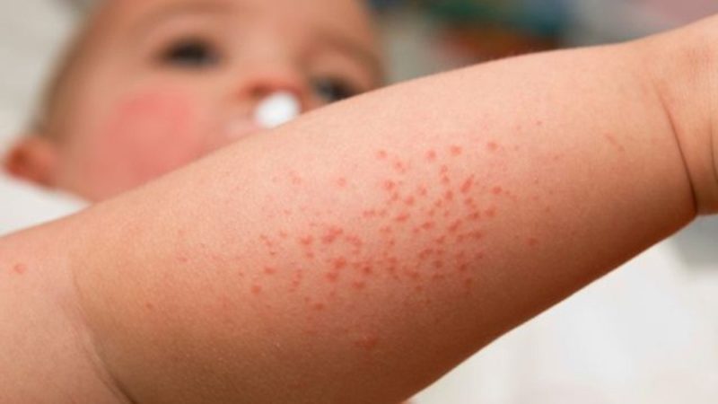 Сыпь при скарлатине у детей и взрослых: как выглядит, чешется или нет, когда появляется, особенности кожных высыпаний