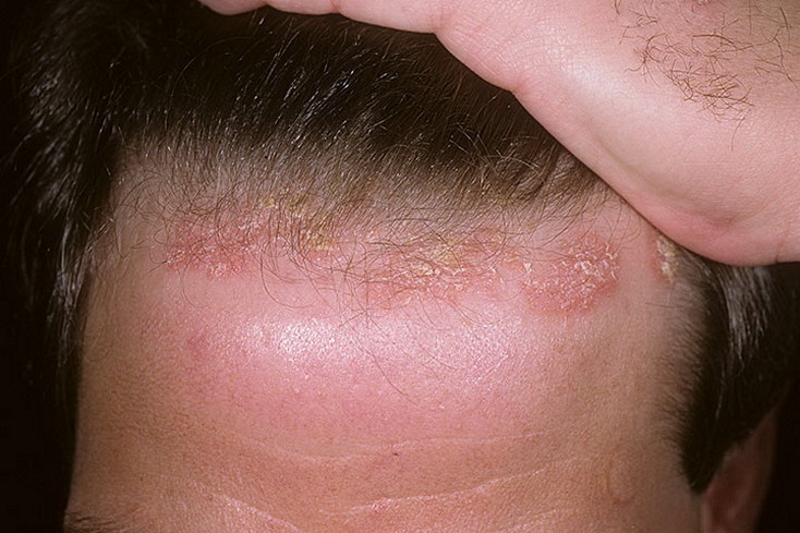Псориаз на голове: симптомы и лечение, препараты и народные средства от псориаза волосистой части головы