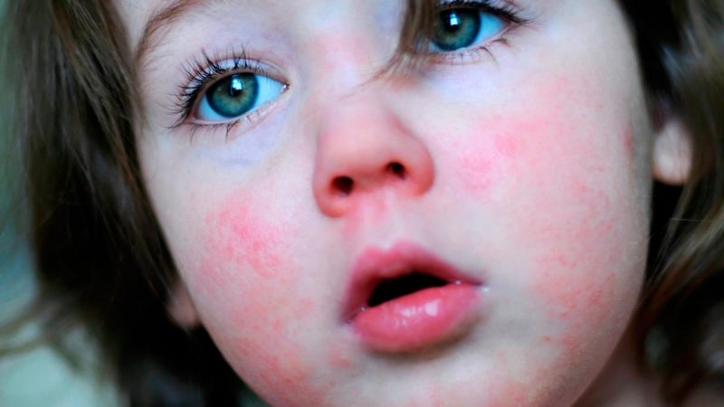 Скарлатина у детей: симптомы и лечение, что это за болезнь и как передается?