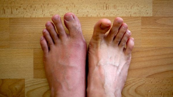Подагра на ногах: симптомы заболевания у женщин и мужчин, диета, эффективные лекарства, лечение в домашних условиях