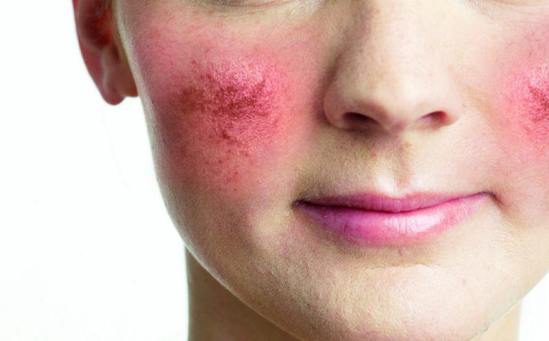 Лечение розацеа на лице: причины, симптомы, препараты и методы лечения розовых угрей