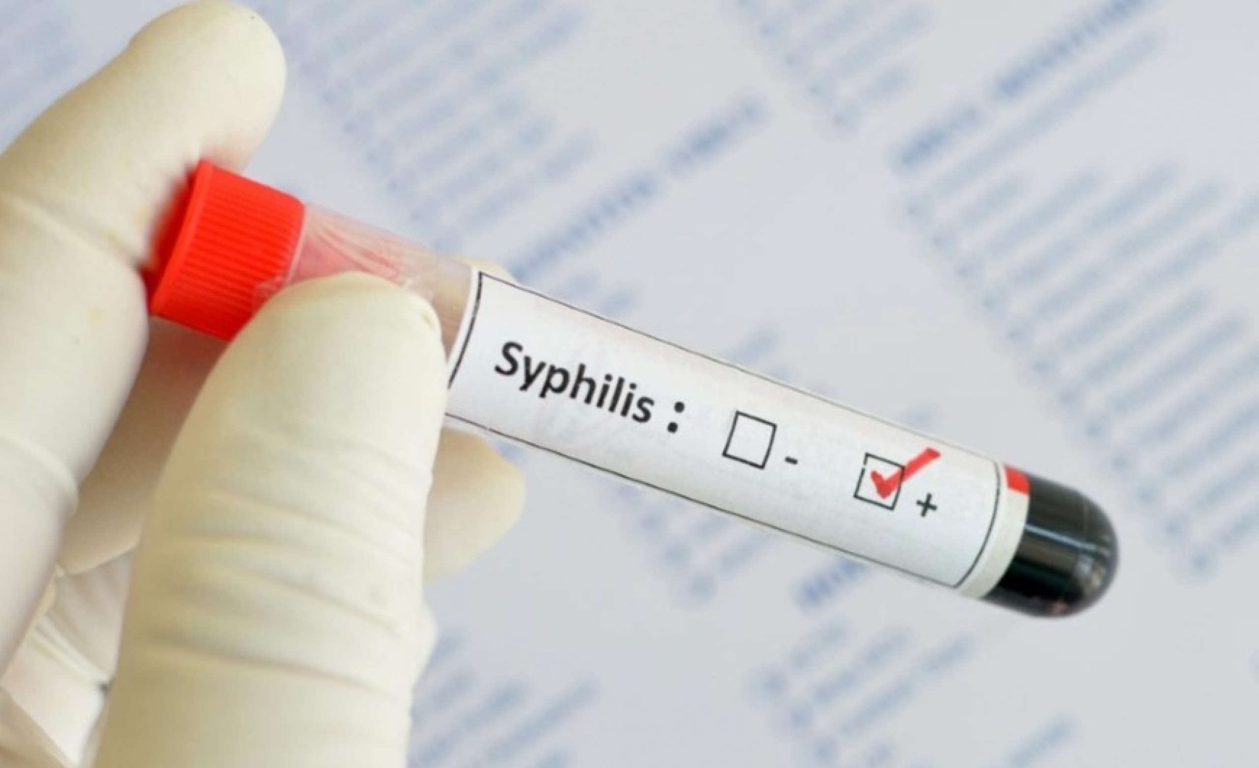 Лечение сифилиса: стадии, симптомы, диагностика инфекционного заболевания, схема лечения, противосифилитические препараты