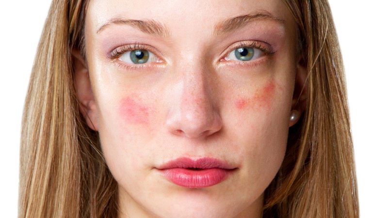 Розацеа: что это такое, причины и лечение розовых угрей на лице