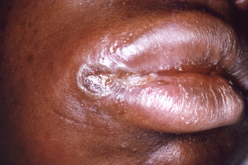 Сифилис: как проявляется у мужчин и женщин, инкубационный период заболевания, первые признаки заражения