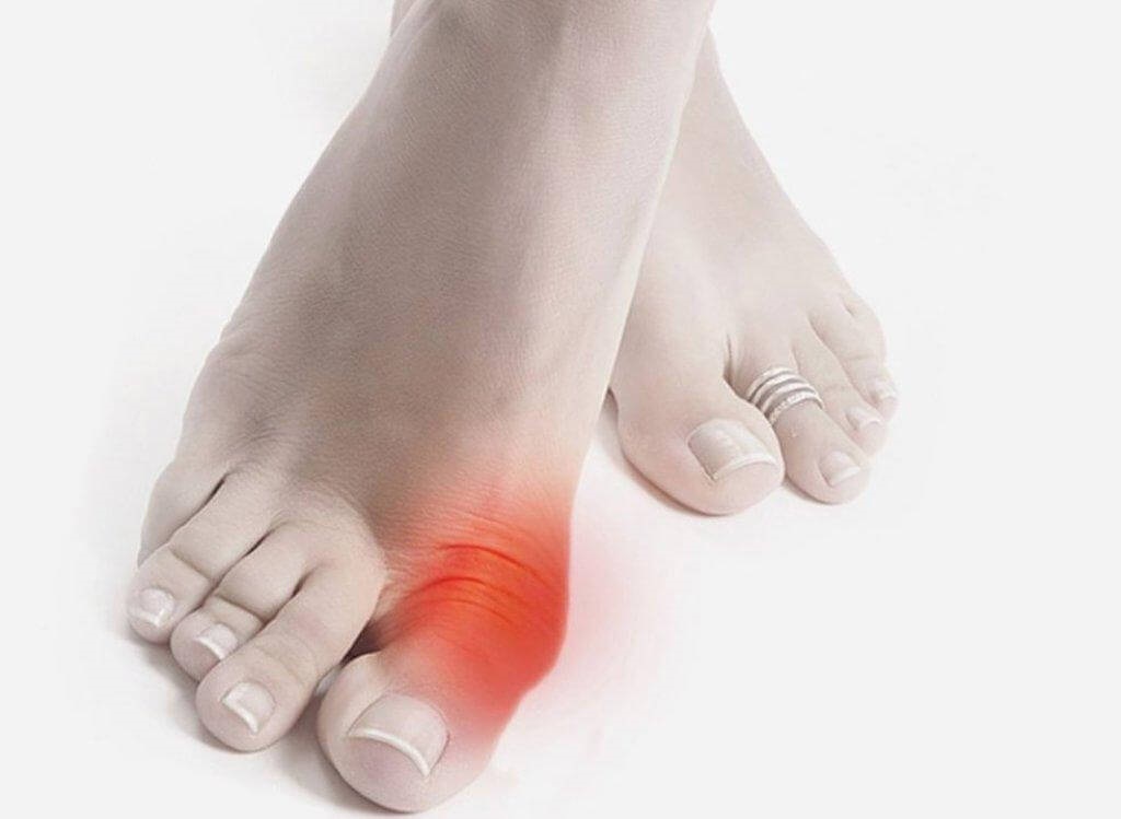 Подагра на ногах: симптомы заболевания у женщин и мужчин, диета, эффективные лекарства, лечение в домашних условиях