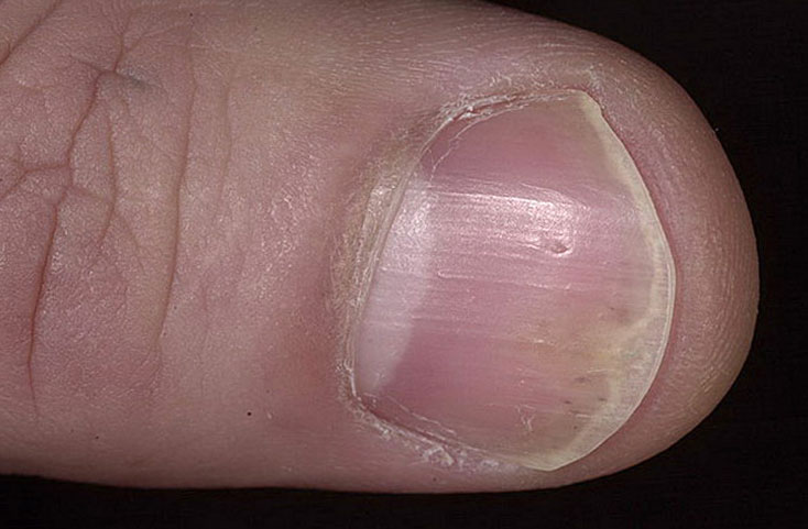 Псориаз ногтей: причины, симптомы и лечение, препараты и народные средства