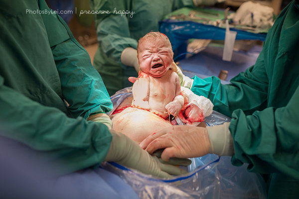 this baby was born by c-section