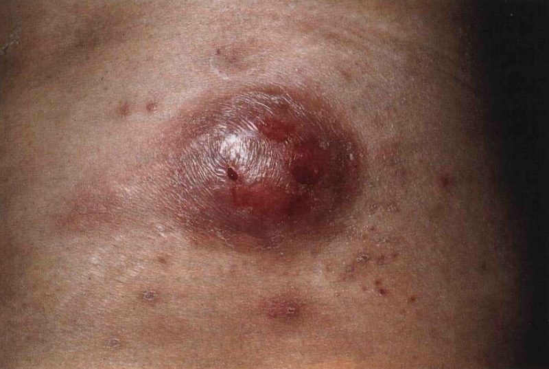 Третичный сифилис: симптомы и признаки, диагностика, схема лечения венерического заболевания